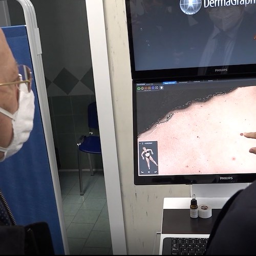 All’Ospedale Ascalesi di Napoli arriva il sistema tecnologicamente più avanzato per la diagnosi del melanoma